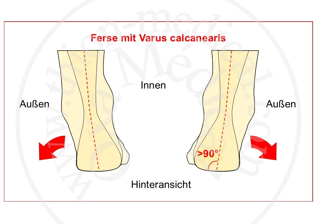 Diagramm des Fuß-Varus
